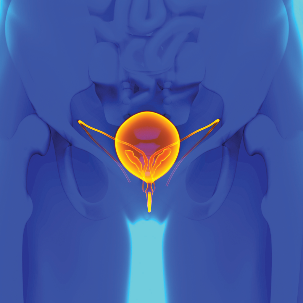 enlarged prostate (BPH) treatment Minnesota - prostate artery embolization