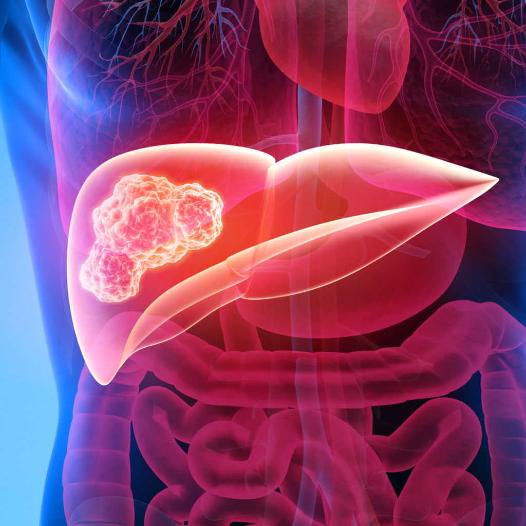 Treatments for Liver Tumors Illustration