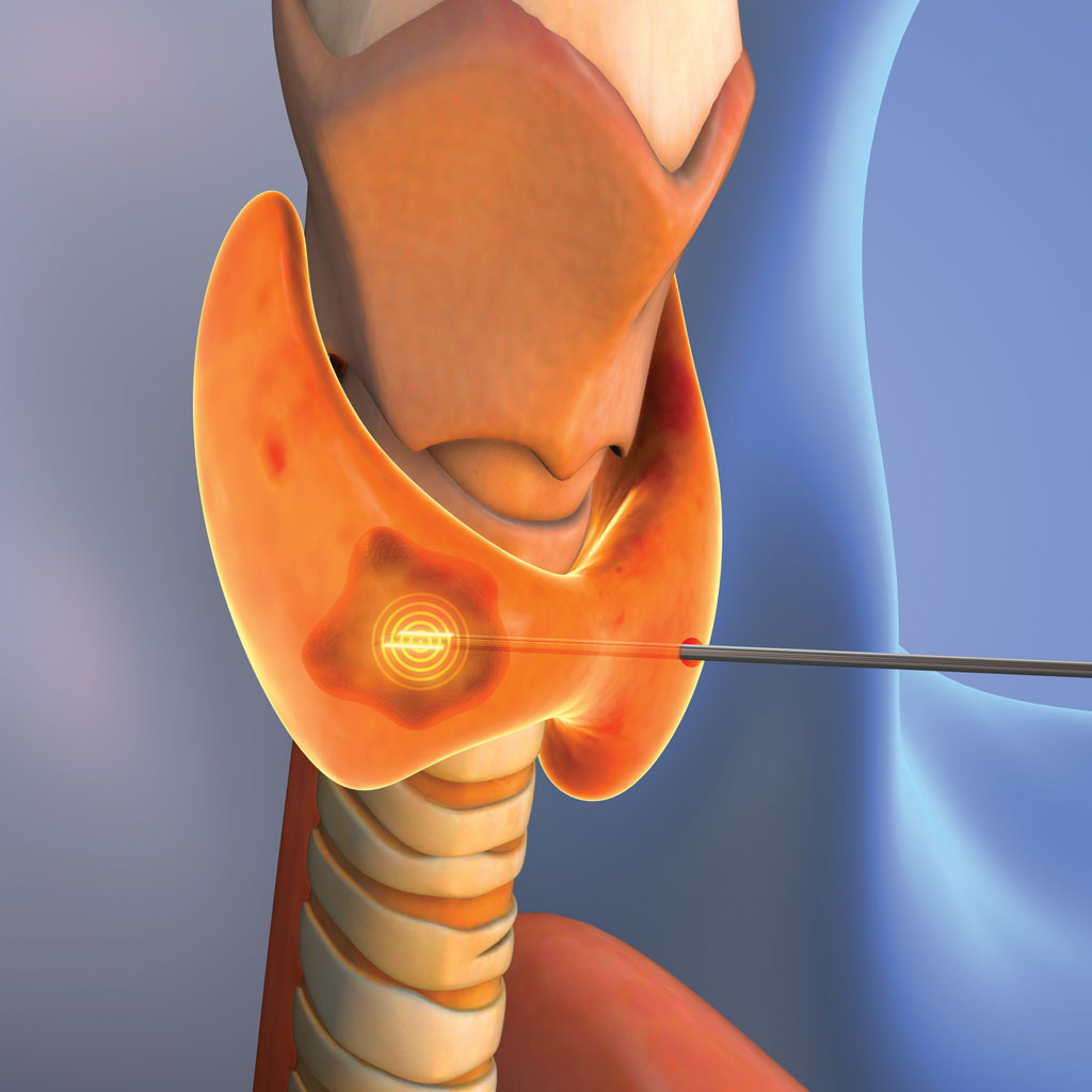 Thyroid Radiofrequency Ablation Illustration