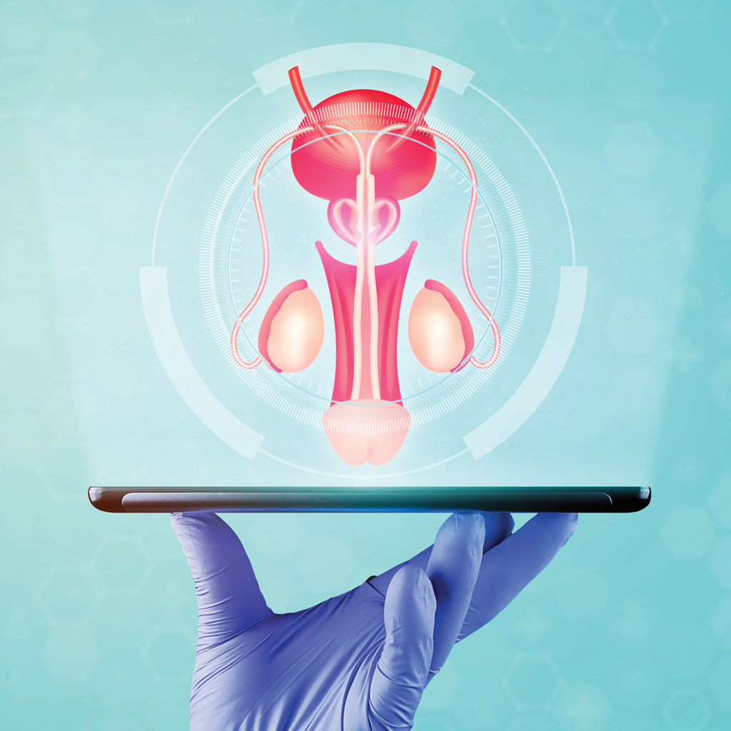Varicocele Embolization Illustration