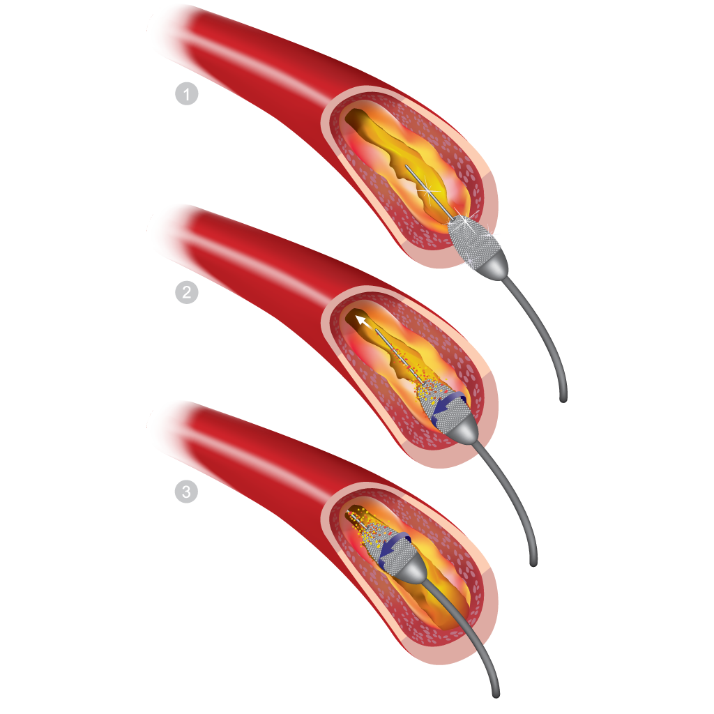 atherectomy for PAD