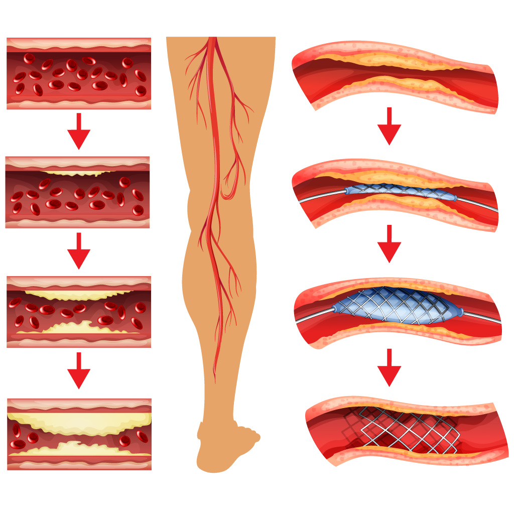 angioplasty for peripheral artery disease