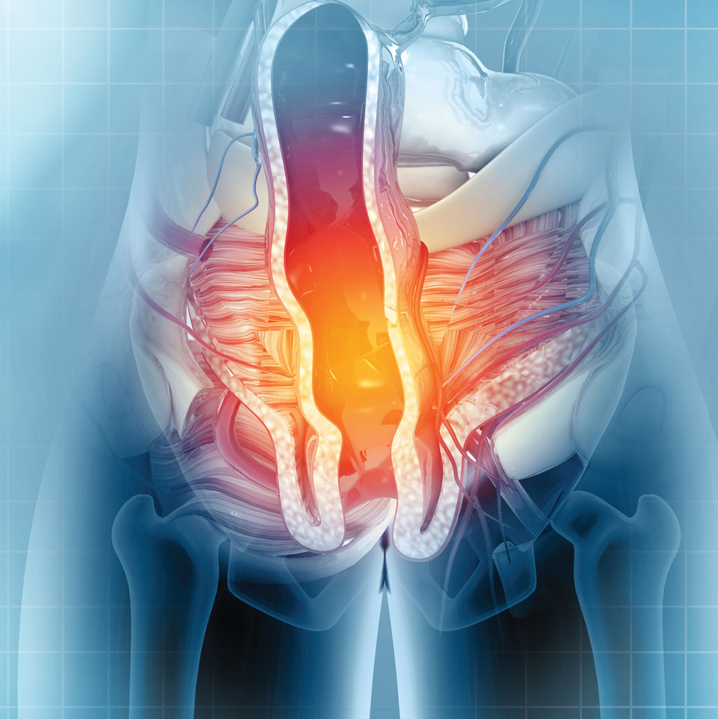 Non-Surgical Option For Hemorrhoids Illustration