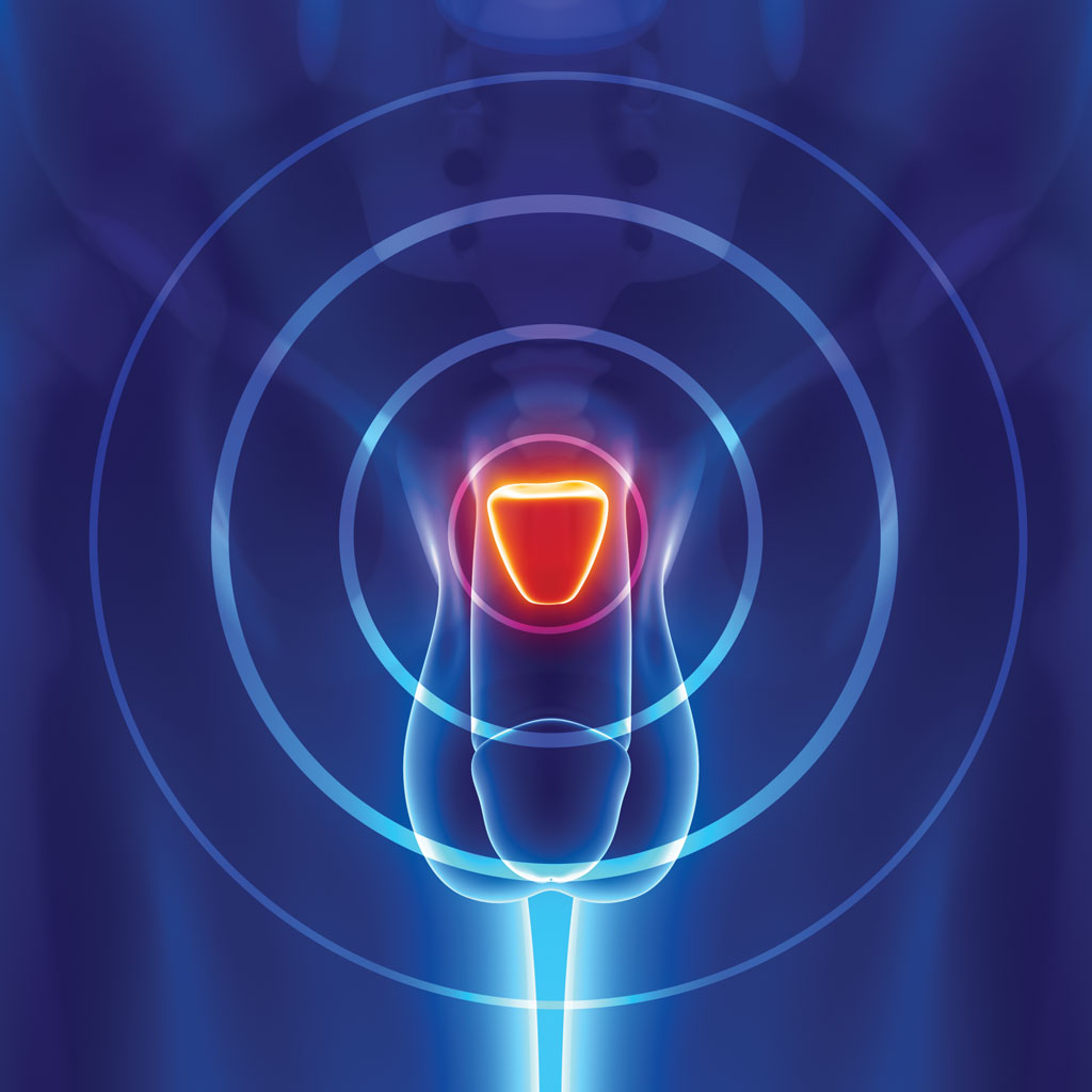 Benign Prostatic Hyperplasia Radar Illustration