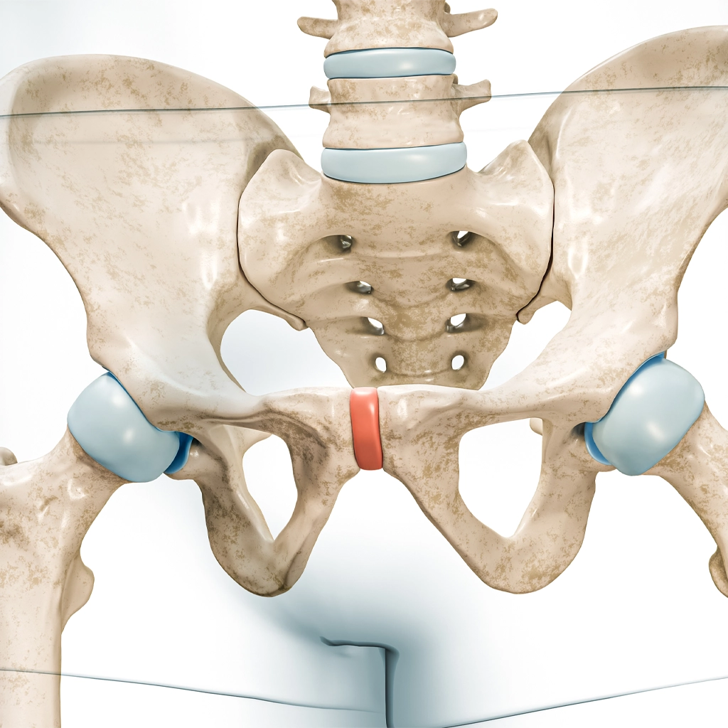 Osteitis Pubis (Pubic Symphysis Inflammation)