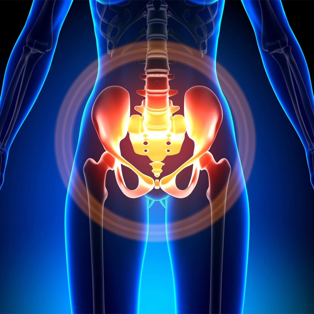 Osteitis Pubis Embolization (OPE)