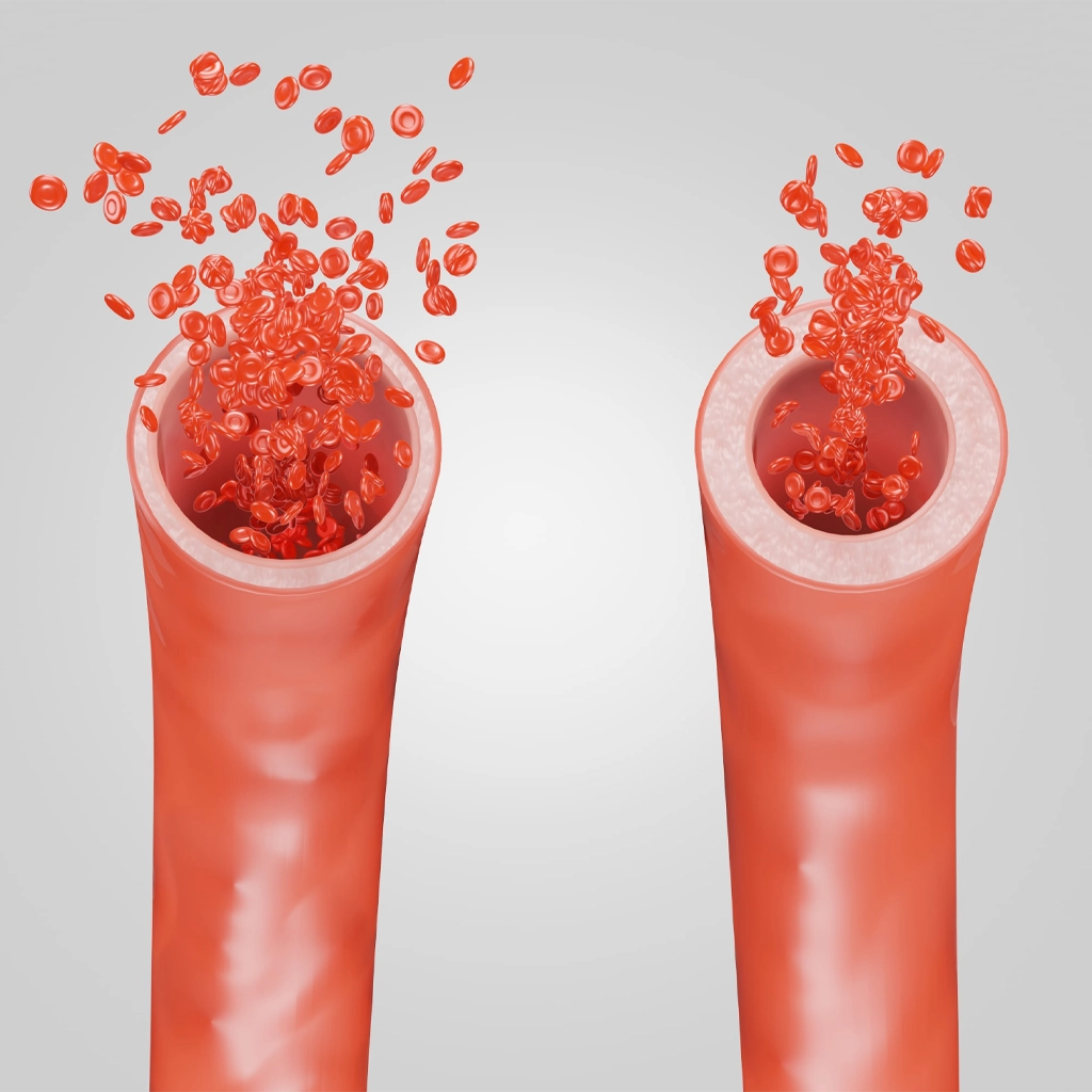 Fibromuscular Dysplasia